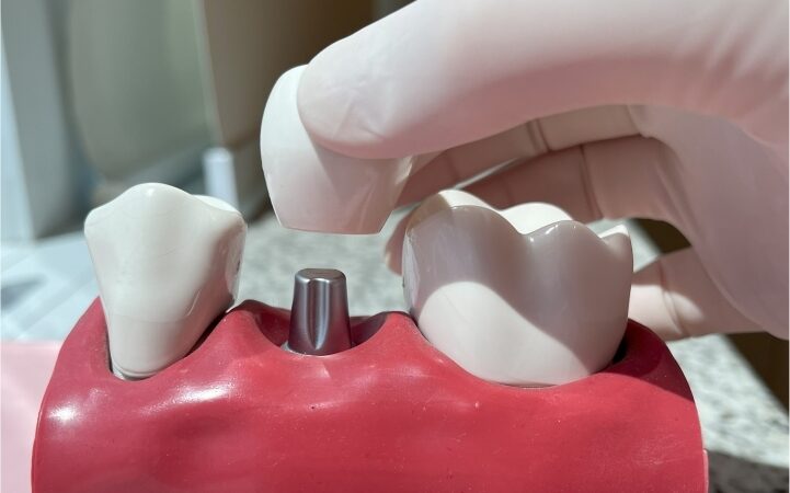 Cresce busca por implantes dentários com tecnologia digital