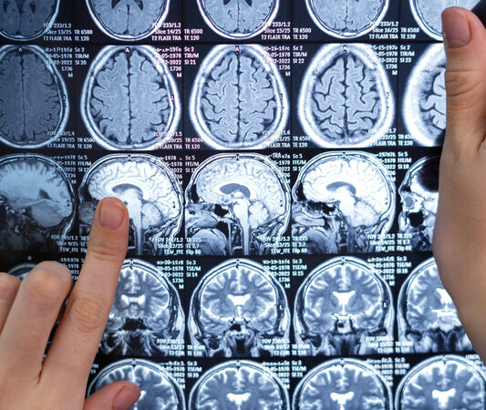 Neurocirurgião esclarece dúvidas sobre tumor cerebral