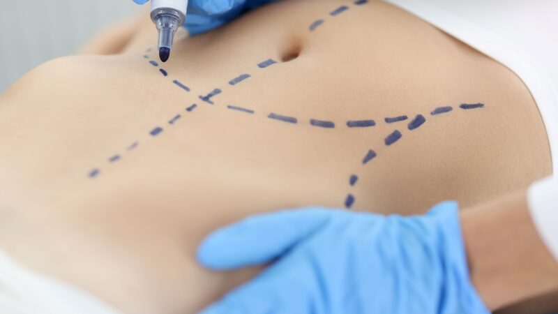 Cirurgia plástica: busca por resultado natural é tendência