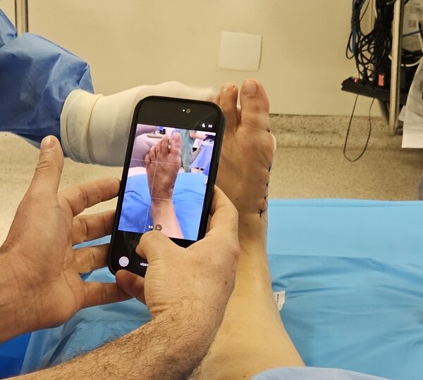 Tratamento das joanetes avança com cirurgia pouco invasiva