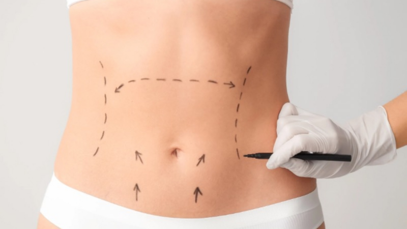 Avanços técnicos ajudam a reduzir cicatrizes cirúrgicas