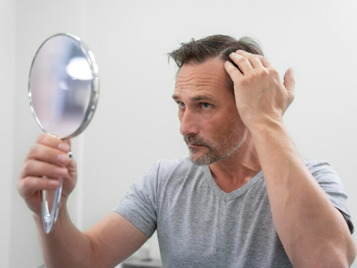 Tratamentos ampliam alternativas para calvície masculina