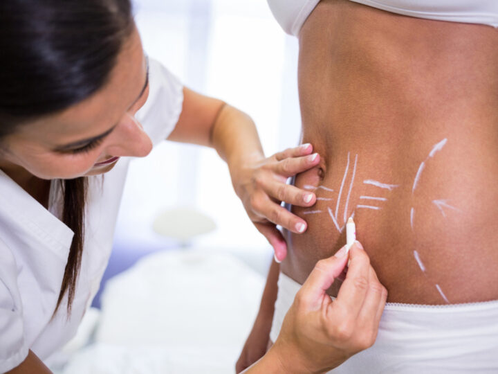 Lipo HD amplia possibilidades da definição corporal