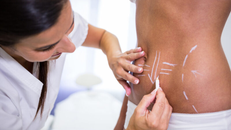 Lipo HD amplia possibilidades da definição corporal
