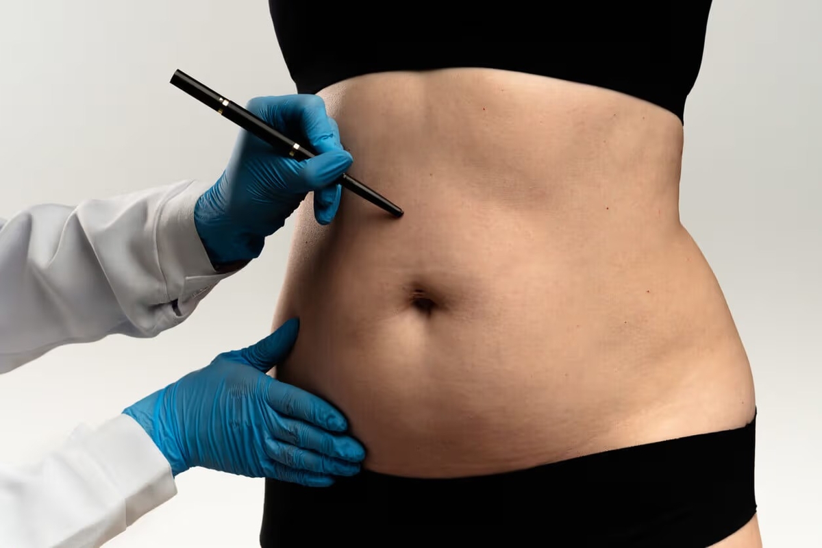 Lipoaspiração lidera preferência por cirurgias plásticas