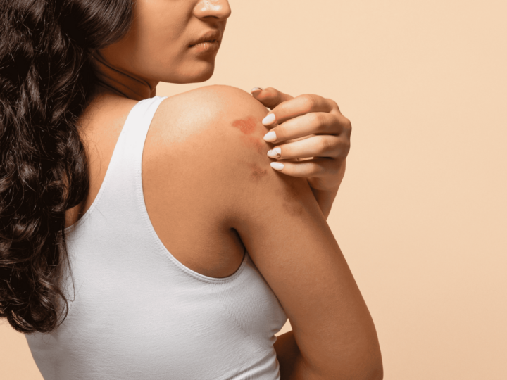 Mês da Dermatite Atópica: os impactos da doença na pele
