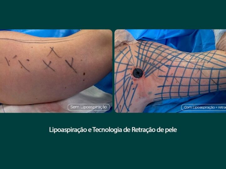 Tratamento remove flacidez do braço com tecnologia associada