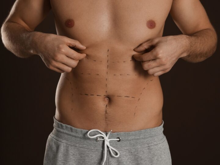 Definição em foco: a evolução da lipoaspiração masculina