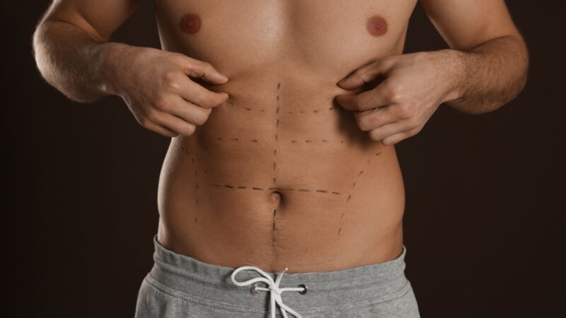 Definição em foco: a evolução da lipoaspiração masculina
