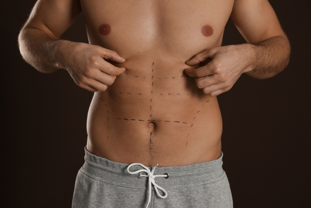 Definição em foco: a evolução da lipoaspiração masculina