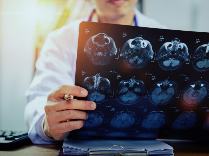 AVC em jovens: traumas leves no pescoço podem causar acidente vascular cerebral