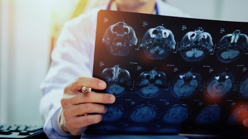 AVC em jovens: traumas leves no pescoço podem causar acidente vascular cerebral